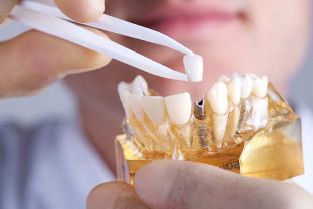 A dentist is holding a model of human teeth, showing how implants fail.