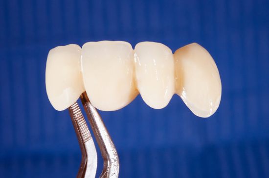 A set of dental crowns after the crown lengthening procedure has taken place.