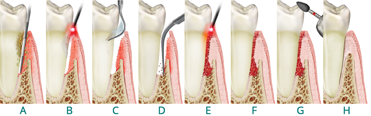 The LANAP Protocol for Periodontitis